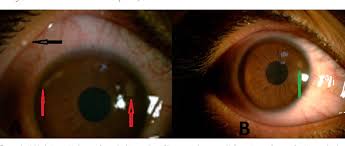 Keratoconus is passed from parents to children in approximately 25% of cases. Keratitis Which Is Developed After Keratoconus Treatment With Corneal Cross Linking Process Its Causes And Treatment Approach A Case Report Keratokonus Tedavisi Icin Korneal Cross Linking Islemi Sonrasi Gelisen Keratitin Nedeni Ve Tedavi Yaklasimi