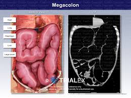 Image result for Megacolon