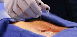15 Frequently Asked Questions About Epidural Steroid Injections Pain Doctor