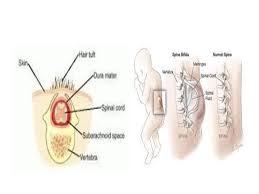 Spina bifida 2 0.21% ensefalokel 1 0.1% meningokel 1 0.1% 2.5 klasifikasi kelainan kongenital sistem saraf pusat menurut european registration of congenital anomalies (2010 ), kelainan bawaan sistem saraf mayor didefinisikan sebagai berikut: Patofisiologi Sistem Saraf Ppt Download