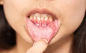 Image result for Canker sores symptoms roof of the mouth