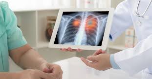 تعرف على أعراض سرطان الرئة الحميد ويب طب