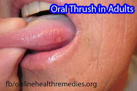 Home Remedies For Oral Thrush In Adults Blister On Tongue Canker Sore Tongue Sores