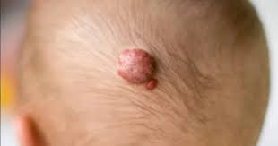 Kepastian apakah benjolan tersebut adalah tumor jinak ataupun kanker harus melalui serangkaian pemeriksaan tambahan. Kenali 10 Jenis Tumor Jinak Berdasarkan Letaknya Serta Cara Deteksinya