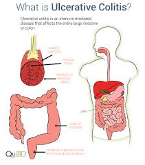 Find updated content daily for popular categories. Ulcerative Colitis Symptoms Ibd Prevalence Impact Causes