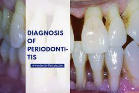 Periodontitis And How To Diagnose It Dental Lifestyle