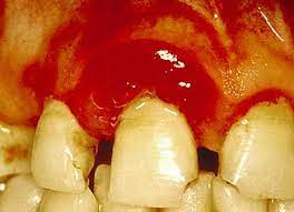 To All With Hashimoto S Because Of Hashi We Have Gum Problems Too Gum Care Dental Implant Procedure Teeth Treatment