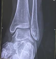 Image result for Ankle XRay