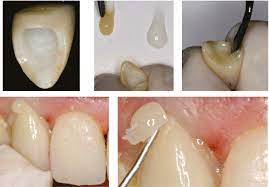 To prevent premature curing and drying of the paste, be sure to follow recommended cleaning Figure 13 From Selection Of Dental Ceramics In An Esthetic Area A Case Report Semantic Scholar