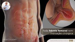 Hernia Inguinal Sintomas E Tratamento Prof Dr Luiz Carneiro Crm 22761 Youtube