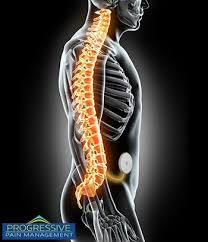 Image result for Intrathecal Pump