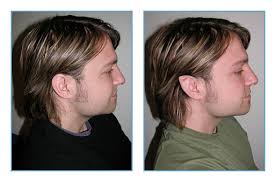 Pre And Post Pointing Elf Ears Pointed Ears Body Modifications