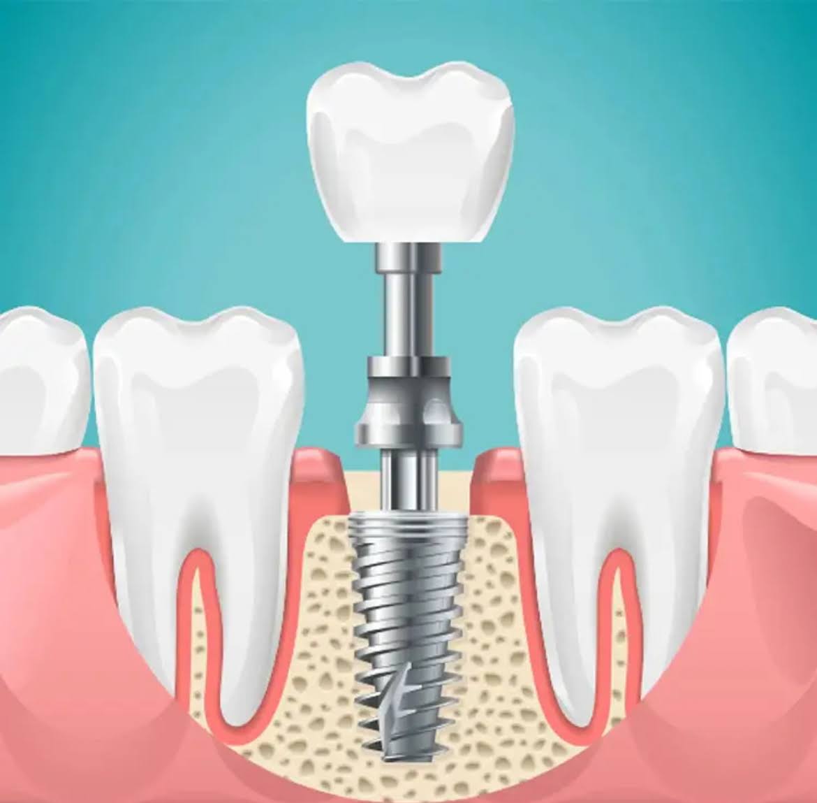 Dental Implants product image