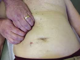 What organ is right under the right side ribs in back? The Slipping Rib Syndrome An Overlooked Cause Of Abdominal Pain