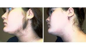 Before And After Laser Hair Removal Facial Waxing Laser Hair Removal Fue Hair Transplant