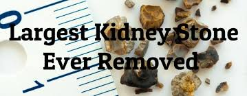 3 Largest Kidney Stones Ever Removed Largest Org