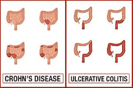 crohns disease vs ulcerative colitis differences in