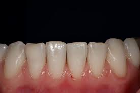 No matter how frightening it sounds, these white spots will we recommend that you first consult your dentist if you are contemplating using teeth whitening to get rid of your white spots. Brown And White Spots On Teeth Micro Invasive Treatment