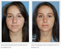 Nasal Nose Tip Refinement For Bulbous Tip Rhinoplasty Seattle Bellevue Dr Philip Young Nose Plastic Surgery Rhinoplasty Plastic Surgery