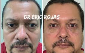 Mejora la sudoración de las axilas.