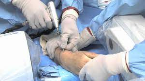 See full list on wikihow.com Broken Wrist Treated With The Cpx By A M Surgical Youtube