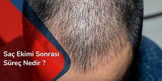 Sac Ekimi Sonrasi Surec Nedir Hair Heal Istanbul