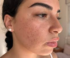 Basic moisturizer for dry and crepey skin