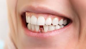 تركيب الاسنان الامامية الانواع والطرق والتكلفة تجميلي
