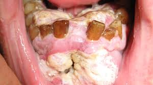 Image result for Canker sores symptoms roof of the mouth