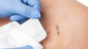 Gently wash the suture and the area around the sutures, being careful not to snag or pull the sutures with the washcloth. How To Know If Your Cut Needs Stitches Or Not