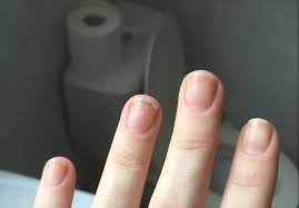 terrys nails liver disease