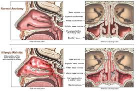 Nasal trauma is defined as any injury to the nose or related structure that may result in bleeding, a physical deformity, a decreased ability to breathe normally because of obstruction, or an impaired. Pediatric Allergic Rhinitis Nasal Allergies
