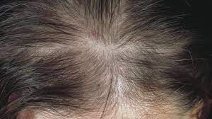 Is androcur/cyproterone acetate (cpa) an effective treatment for hair loss? Alopecia Androgenetica In Women Altmeyers Encyclopedia Department Dermatology