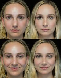 The medical necessity in this case is because of acute breathing difficulty. Your Guide To Rhinoplasty From Cost To Recovery Time Life In Plastic Allure