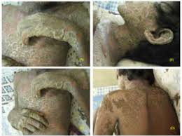 Image result for scabies norvegica