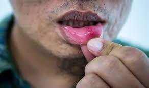 Mouth cancer can appear in any part of your mouth including the floor of your mouth, roof, cheeks and gums. Mouth Cancer Symptoms Three Common Signs Of The Disease To Watch For Including An Ulcer Express Co Uk