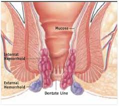 Often, the first sign that internal hemorrhoids are present is rectal bleeding. A New Treatment Option For Grades Iii And Iv Hemorrhoids Mdedge Family Medicine