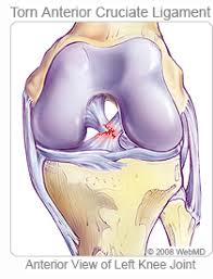 Arthoscopic knee surgery may be required for lcl complete tears or a meniscus. Tiger Woods Stress Fracture And Torn Acl Information On Medicinenet Com