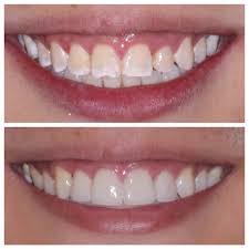 Top 10 best cosmetic dentists in new york, ny · lumia dental. Cosmetic Dentistry Nyc Smile Spa Upper East Side