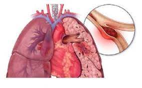 L'embolia polmonare è una patologia causata dall'ostruzione di un vaso sanguigno a livello del polmone. Coronavirus La Tromboembolia Polmonare Puo Essere Causa Di Tanti Decessi Osservatorio Malattie Rare