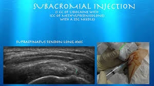 Image result for Subacromial Space Injection
