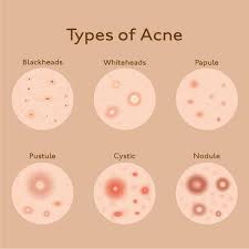 Check spelling or type a new query. How To Get Rid Of Pimples Naturally A Complete Guide Kama Ayurveda