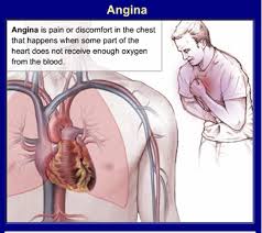 We did not find results for: What Do We Mean By Atypical Chest Pain Dr S Venkatesan Md
