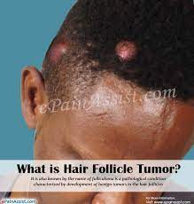 Hence hair fall always doesn't indicate a serious problem. What Is Hair Follicle Tumor Or Folliculoma Causes Symptoms Treatment
