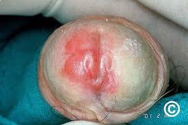 Image result for penis mycosis symptoms