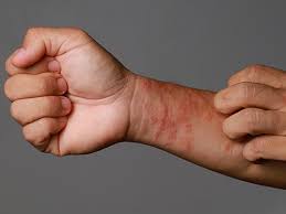 Image result for Atopic eczema atopic dermatitis