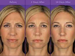 Both last for approximately four months, with some variation between patients. Botox Joplin Xeomin Dysport Injectables Wrinkle Treatment Springfield Derma Tech