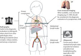 A cough that lasts more than three weeks. Advanced Imaging Tools For Childhood Tuberculosis Potential Applications And Research Needs The Lancet Infectious Diseases