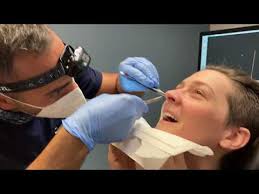 A wide variety of nasal splint options are available to you, such as properties. Septoplasty Nasal Splint Removal Youtube