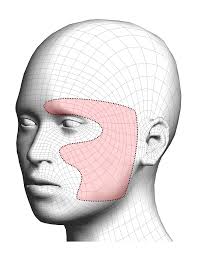 Distribution of the patient's facial sensory symptoms. The patient...